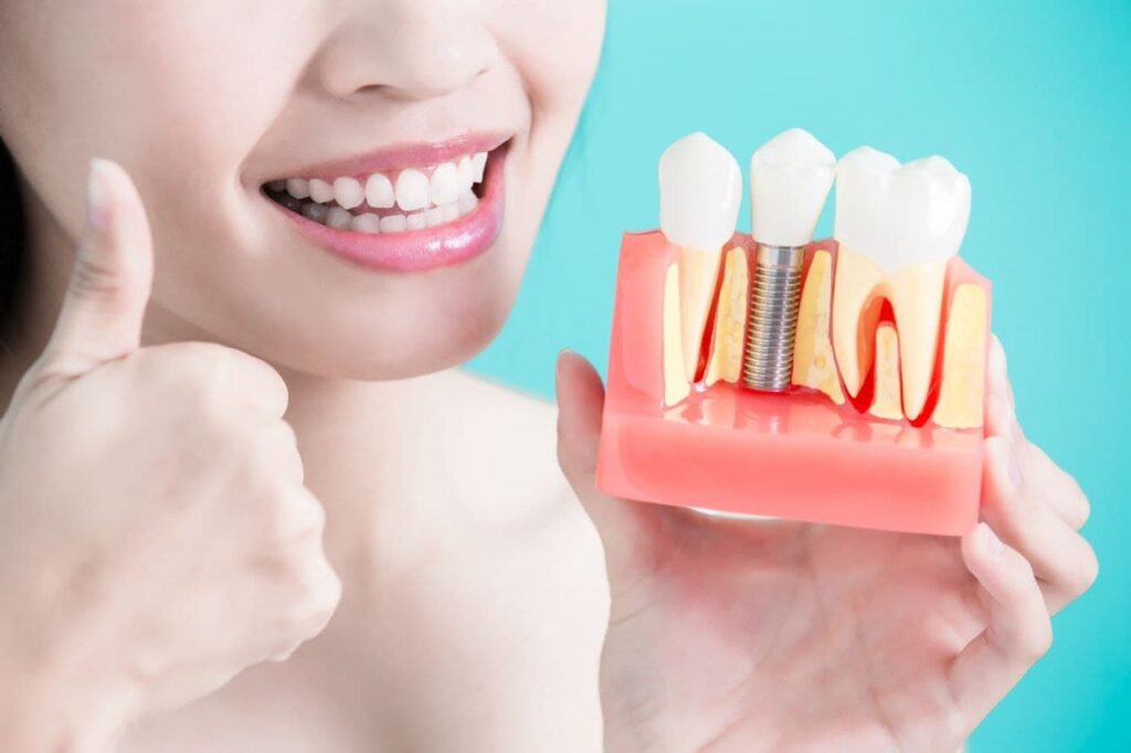 Dental Implants in Dubai