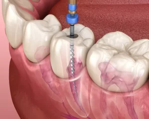 root canal treatment in dubai
