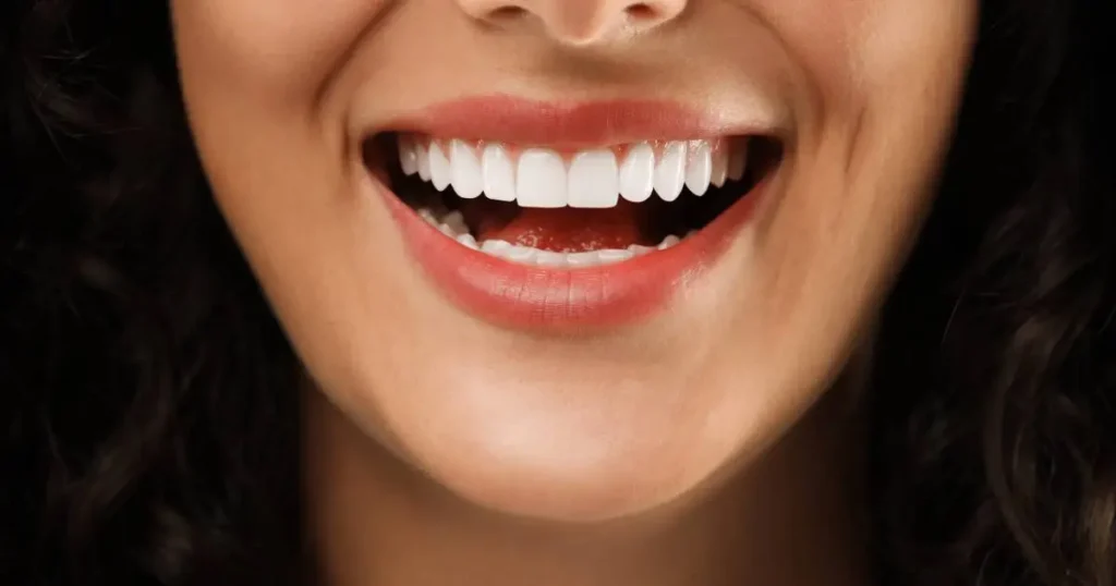 veneers dubai