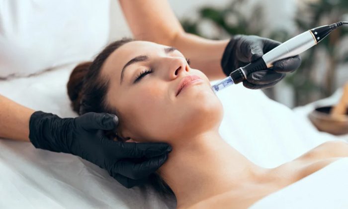 Microneedling Treatment